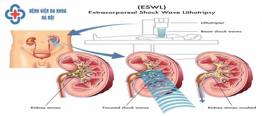 Tán sỏi bằng sóng siêu âm là kỹ thuật điều trị đã lỗi thời