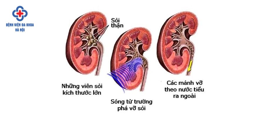 Mô phỏng quá trình tán sỏi ngoài cơ thể mo phong tan soi ngoai co the