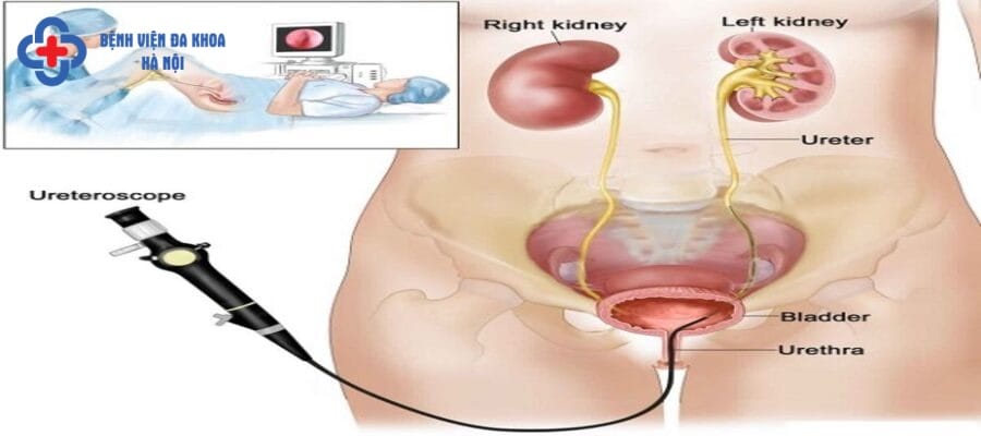 Tán sỏi niệu quản ngược dòng được thực hiện theo quy trình hiện đại