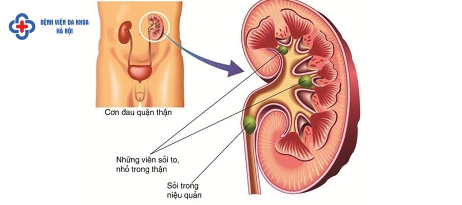 Sỏi niệu quản gây nên nhiều biến chứng nếu không được chữa trị