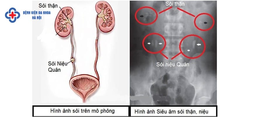 Điều trị sỏi niệu quản sớm tránh được nhiều biến chứng