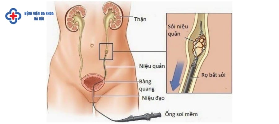 Tán sỏi nội soi ngược dòng là phương pháp an toàn Tán sỏi nội soi ngược dòng