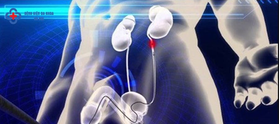 Sỏi niệu quản nên được điều trị sớm