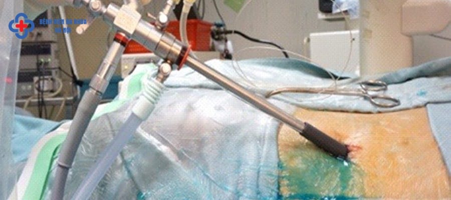 Tán sỏi qua da ít xâm lấn, bệnh nhân nhanh hồi phục