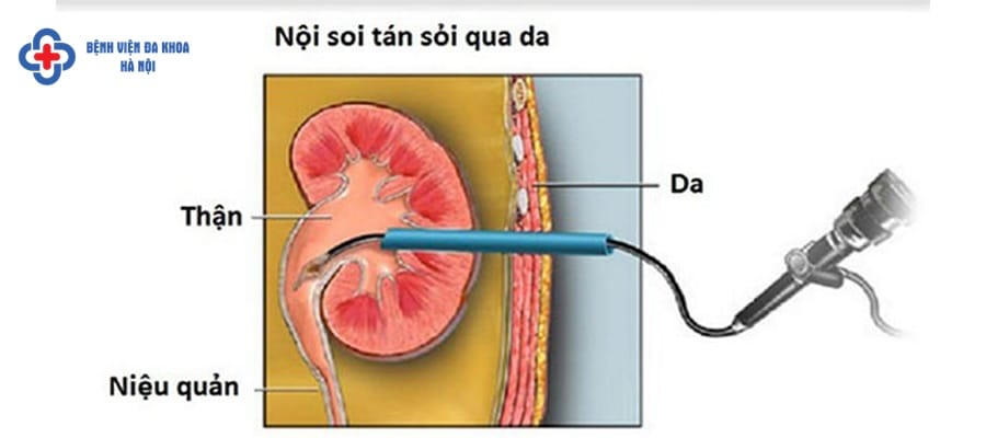 Tán sỏi an toàn, hiệu quả tại bệnh viện đa khoa Hà Nội sỏi thận 4mm có nguy hiểm không