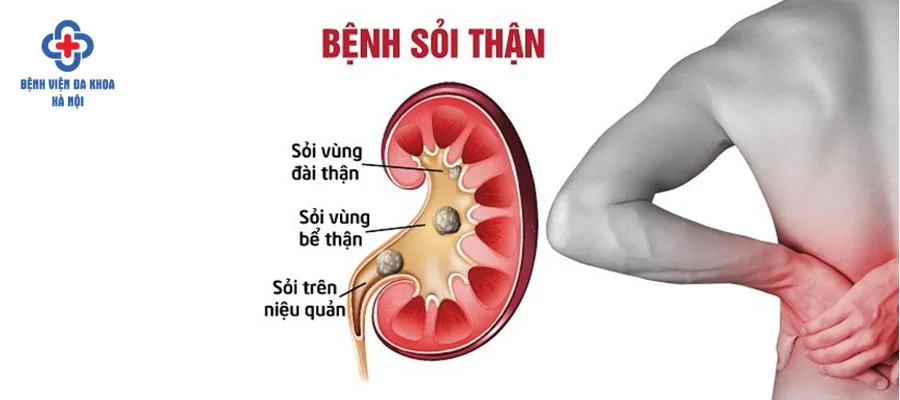 Sỏi thận nên được tán sớm để ngăn ngừa biến chứng