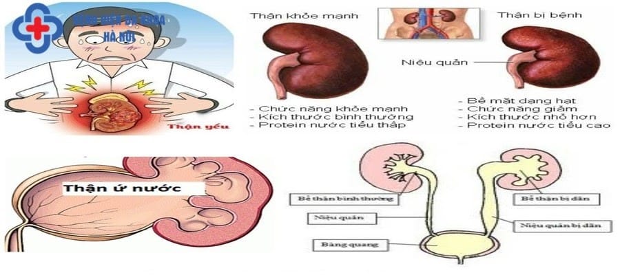 Thận ứ nước gây tắc nghẽn cuống thận