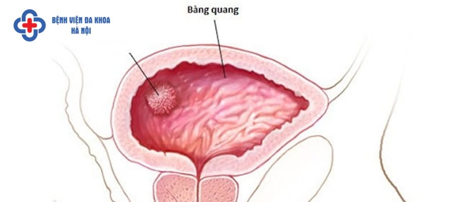 Thiết bị y tế trong bàng quang gây sỏi