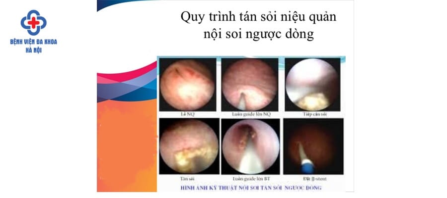 Kỹ thuật tán sỏi ngược dòng niệu quản