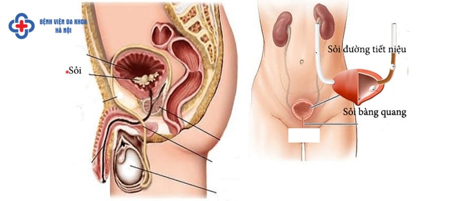 Sỏi bàng quang cần được điều trị sớm để tránh biến chứng trieu chung soi bang quang