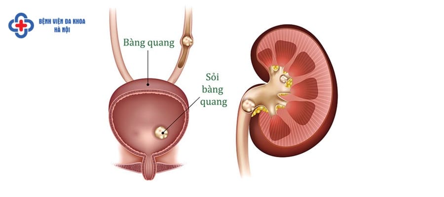 Nhận biết sỏi bàng quang căn cứ vào các dấu hiệu ở đường tiết niệu trieu chung soi bang quang