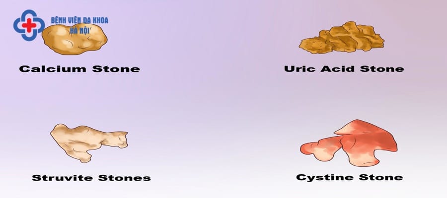Tùy thuộc từng loại sỏi mà có cách điều trị khác nhau