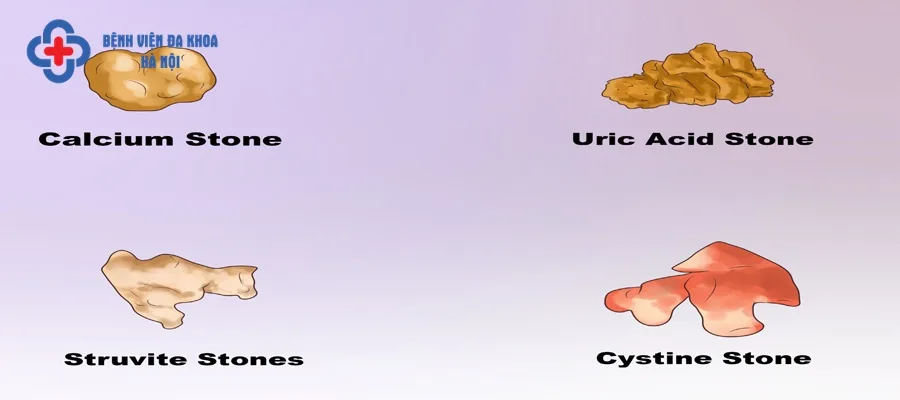 Tùy thuộc từng loại sỏi mà có cách điều trị khác nhau