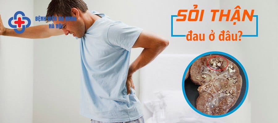 Sỏi to có thể gây tắc nghẽn niệu quản