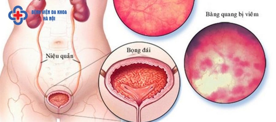 Viêm bàng quang là biến chứng thường gặp