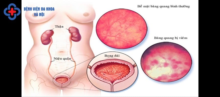 Viêm bàng quang là căn bệnh không còn xa lạ hiện nay