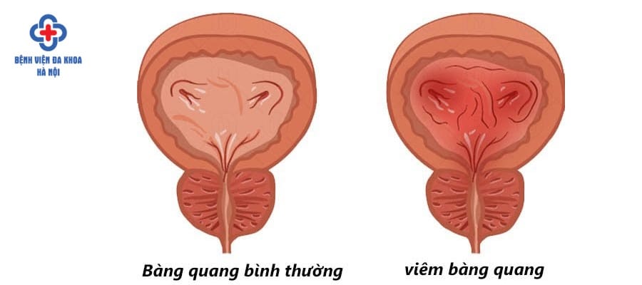 Viêm bàng quang ở nam giới do nhiều nguyên nhân