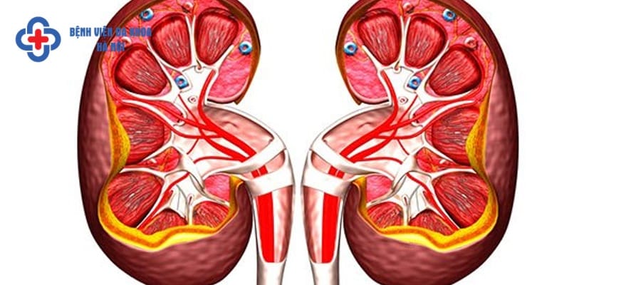 Viêm bể thận mãn tính
