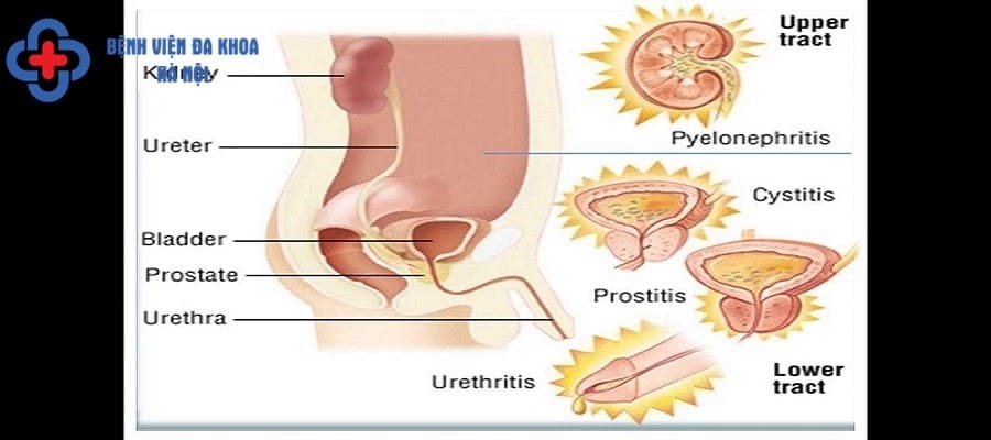Viêm đường tiết niệu là căn bệnh thường gặp hiện nay