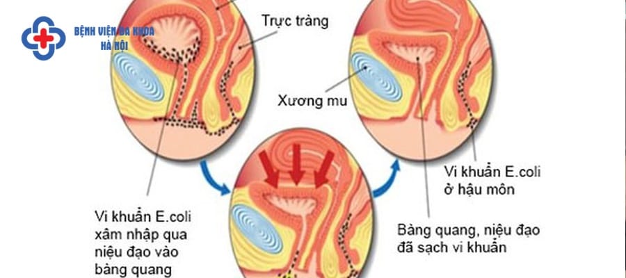 Viêm đường tiết niệu là căn bệnh thường gặp