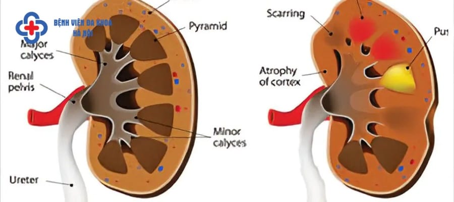 Viêm đường tiết niệu tại thận ít lây nhiễm hơn cả