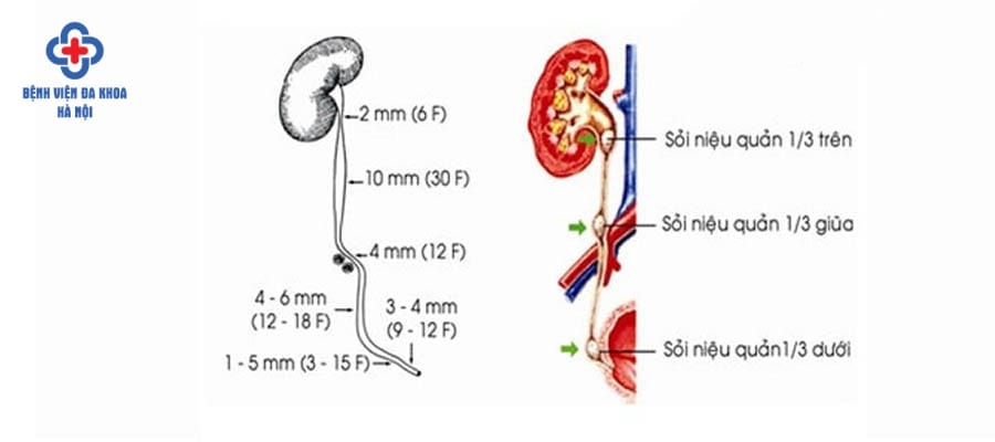 Sỏi niệu quản dưới ảnh hưởng đến sức khỏe người bệnh Điều trị sỏi niệu quản 1/3 dưới
