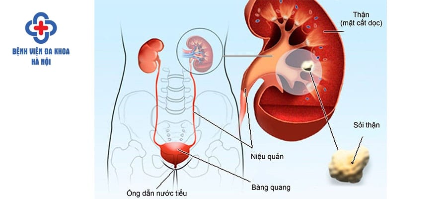 Siêu âm phát hiện các bệnh về thận sớm hơn siêu âm thận tiết niệu