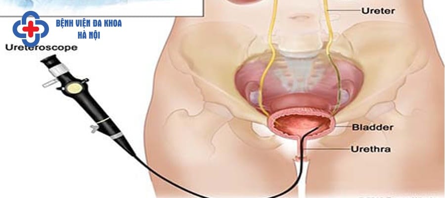 Kỹ thuật tán sỏi qua nội soi niệu quản