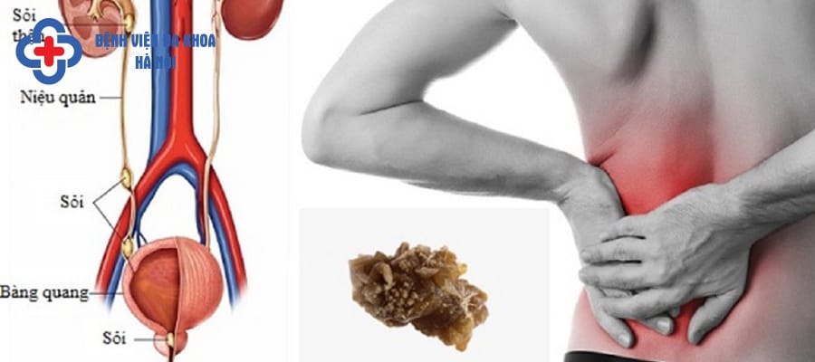 Mảnh sỏi còn sót lại trong hệ tiết niệu gây đau