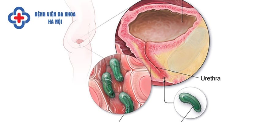 Nhiễm khuẩn đường tiết niệu do vi khuẩn E.Coli xâm nhập