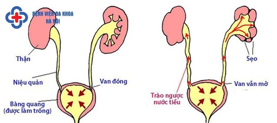 Nước tiểu trào ngược gây đau cho người bệnh