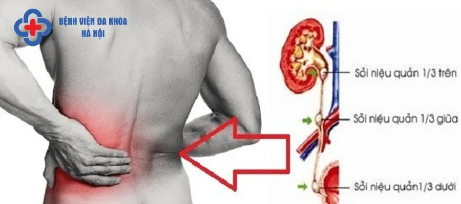 Sỏi niệu quản ⅓ dưới