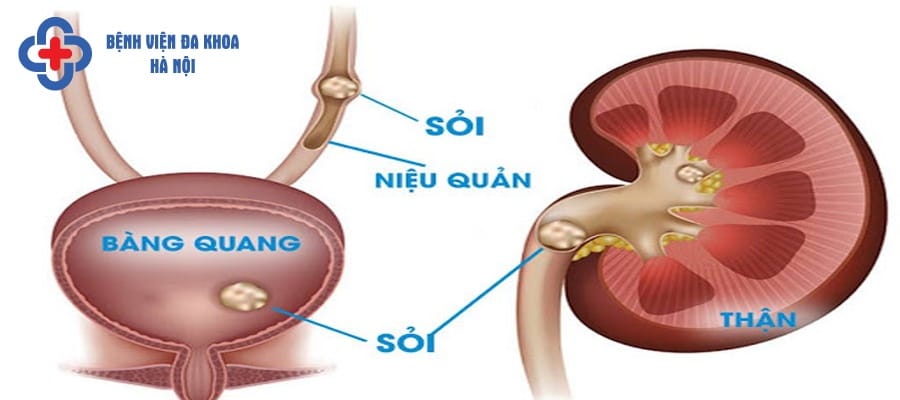 Sỏi niệu quản là tình trạng bệnh mà nhiều người gặp phải