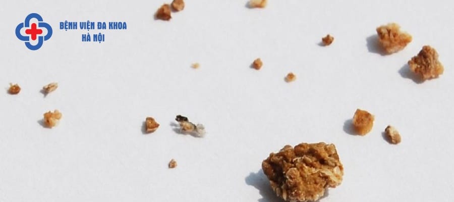 Sỏi niệu quản ⅓ trên <6mm điều trị nội khoa hiệu quả