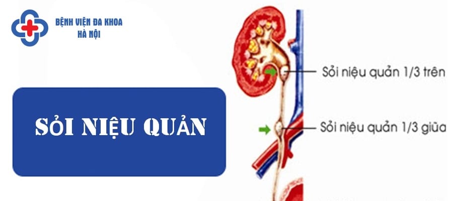 Sỏi niệu quản ⅓ trên là vị trí thường xuất hiện sỏi