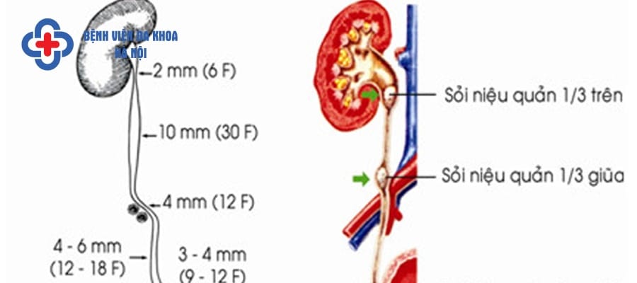 Sỏi niệu quản vị trí ⅓ trên