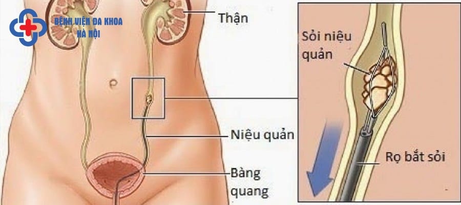 Sỏi niệu quản xuất hiện dưới dạng tinh thể rắn tại hệ tiết niệu