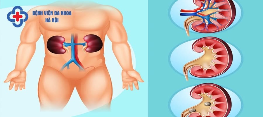 Sỏi thận hình thành khi lắng đọng các khoáng chất trong nước tiểu