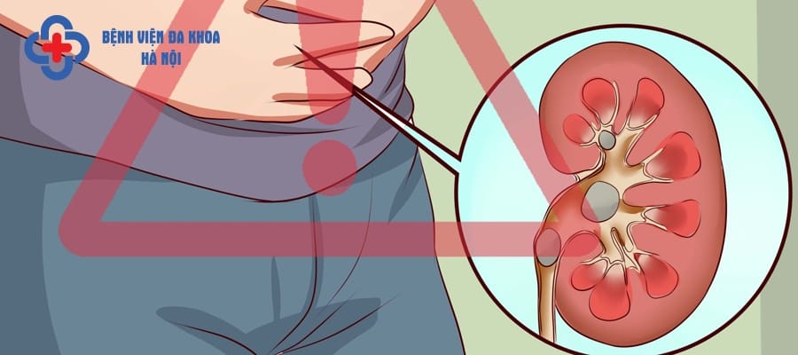Sỏi thận là căn bệnh thường gặp hiện nay