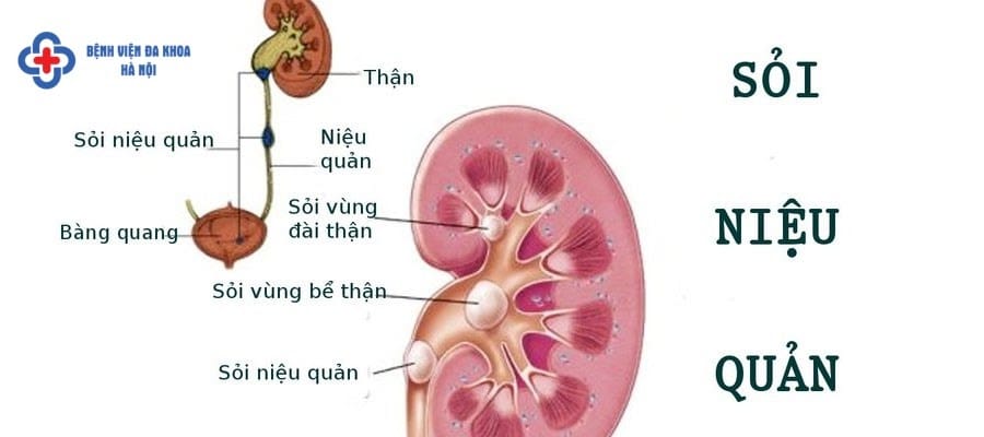 Sỏi từ thận rơi xuống niệu quản tạo thành sỏi niệu quản