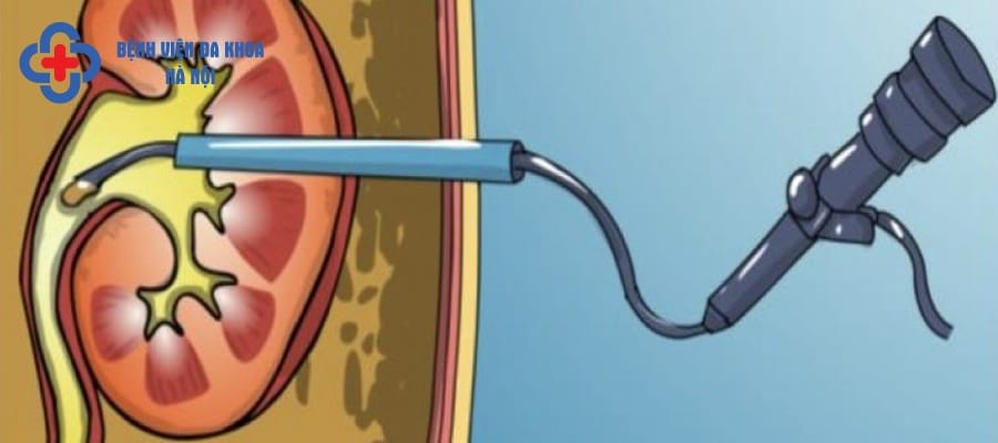 Tán sỏi là phương pháp điều trị an toàn và hiệu quả