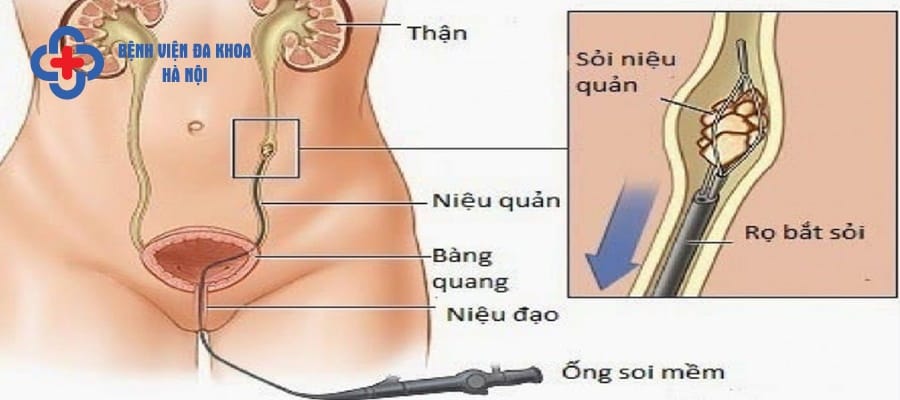Tán sỏi niệu quản là phương pháp điều trị của y khoa hiện đại