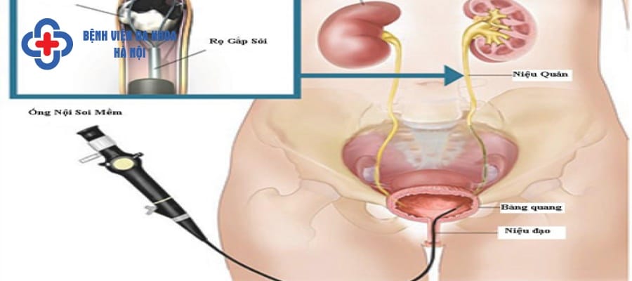 Tán sỏi niệu quản ngược dòng được ứng dụng điều trị sỏi niệu quản hiệu quả