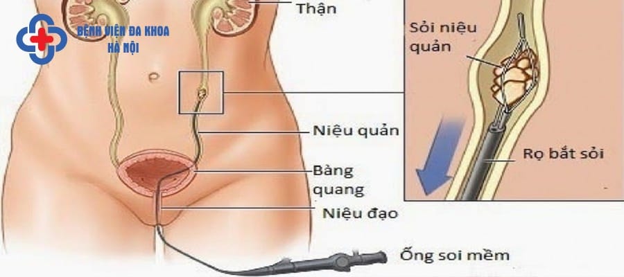 Tán sỏi qua niệu quản ngược dòng