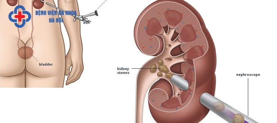 Tán sỏi thận có nhiều ưu điểm hơn so với mổ mở