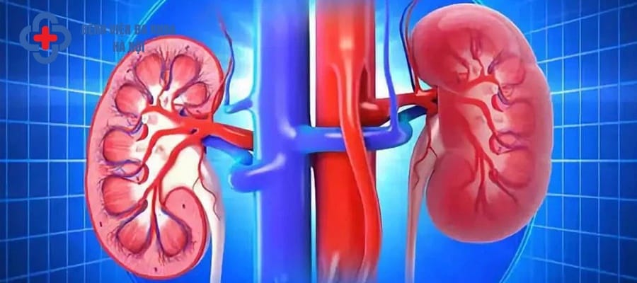 Thận ứ nước là biến chứng sỏi niệu quản ⅓ dưới