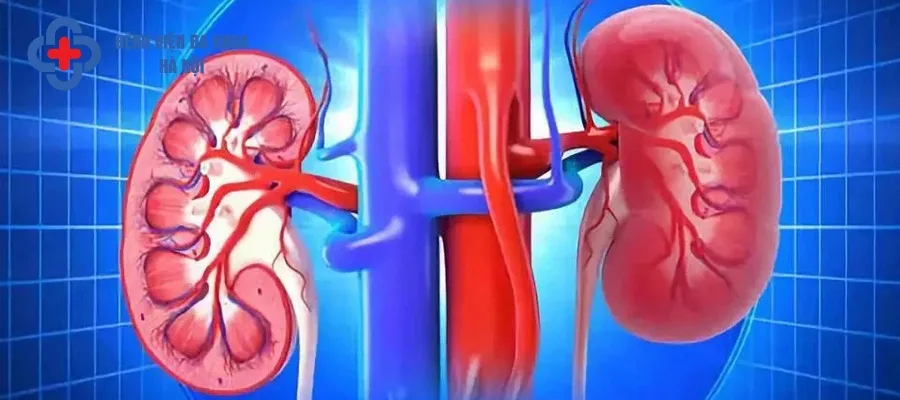 Thận ứ nước là biến chứng sỏi niệu quản ⅓ dưới