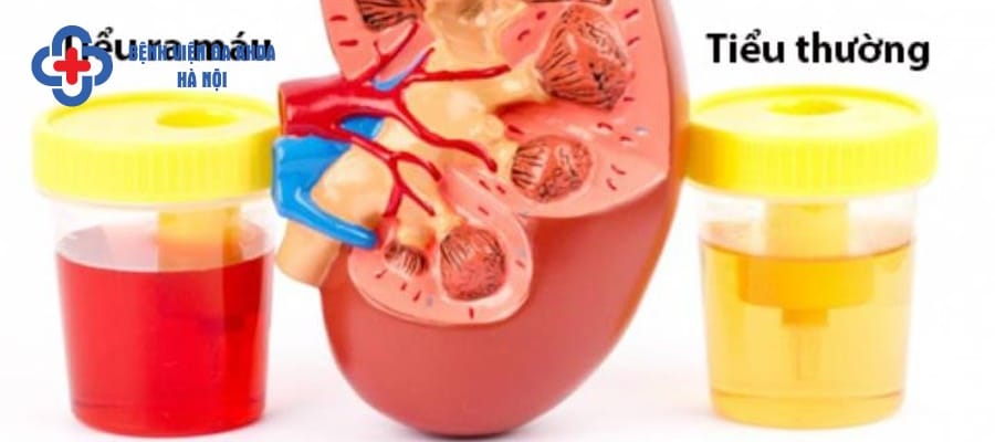 Tiểu ra máu dẫn tới thiếu máu ở người bệnh