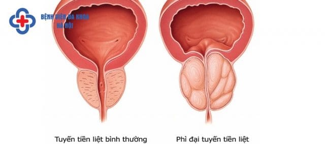 Tuyến tiền liệt u phì tạo áp lực lên bàng quang