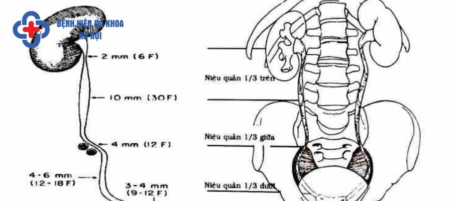 Vị trí sỏi niệu quản ⅓ giữa